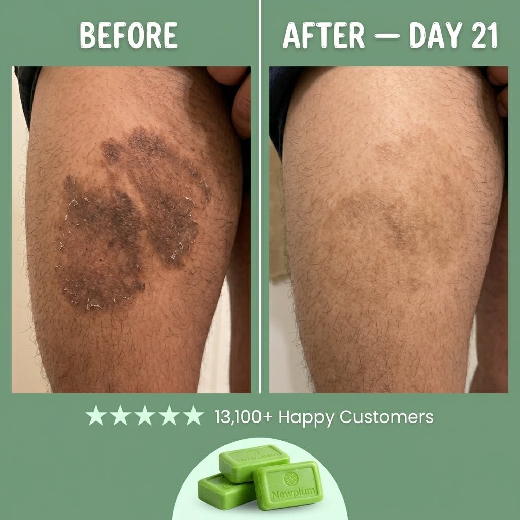 Newplum Antifungal Soap Buy 3, Get 2 Free - Newplum